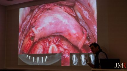 Curso Regeneración Ósea Guiada - Clínica Borg Center Barcelona 2022