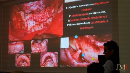 Curso Regeneración Ósea Guiada - Clínica Borg Center Barcelona 2022
