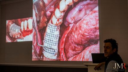 Curso Regeneración Ósea Guiada - Clínica Borg Center Barcelona 2022